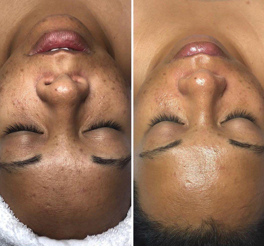 Microneedling before and after