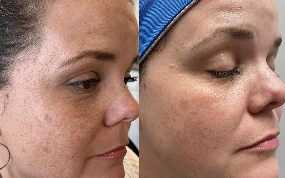 Microneedling before and after at Grace Beauty Studio